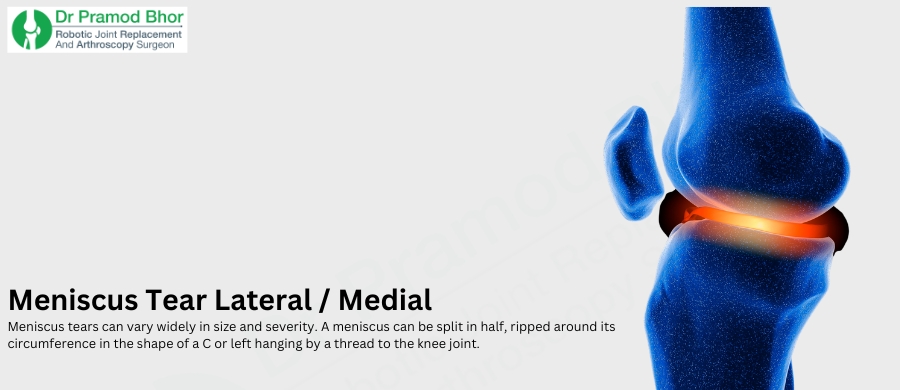 meniscus tear lateral and medial